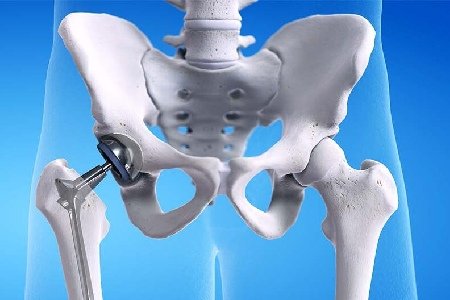 Hip Replacement2-1