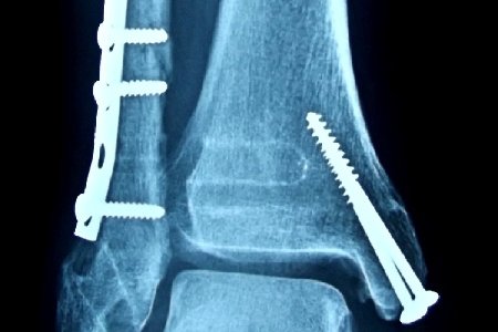 bone-fracture3-1